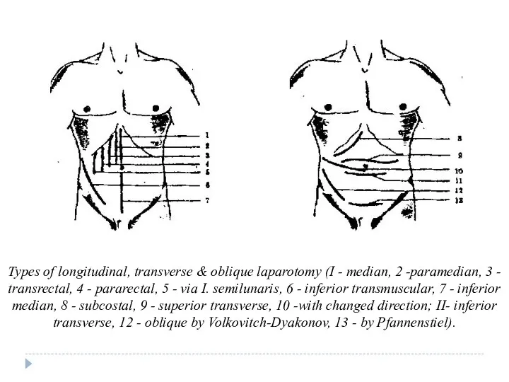 Types of longitudinal, transverse & oblique laparotomy (I - median,