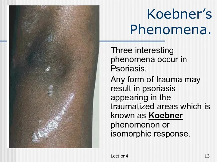 Lection4 Koebner’s Phenomena. Three interesting phenomena occur in Psoriasis. Any