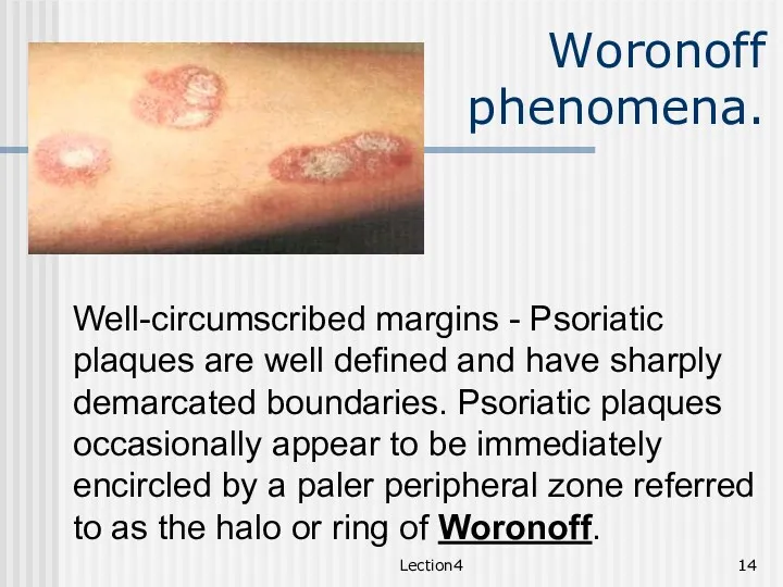 Lection4 Woronoff phenomena. Well-circumscribed margins - Psoriatic plaques are well