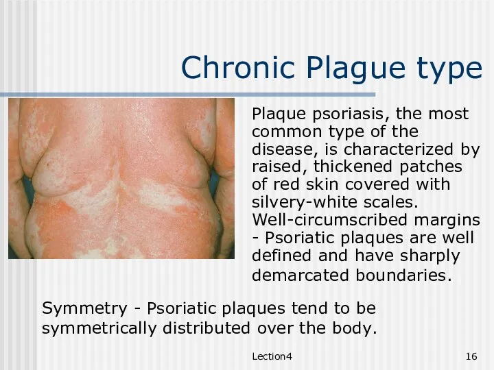 Lection4 Chronic Plague type Plaque psoriasis, the most common type