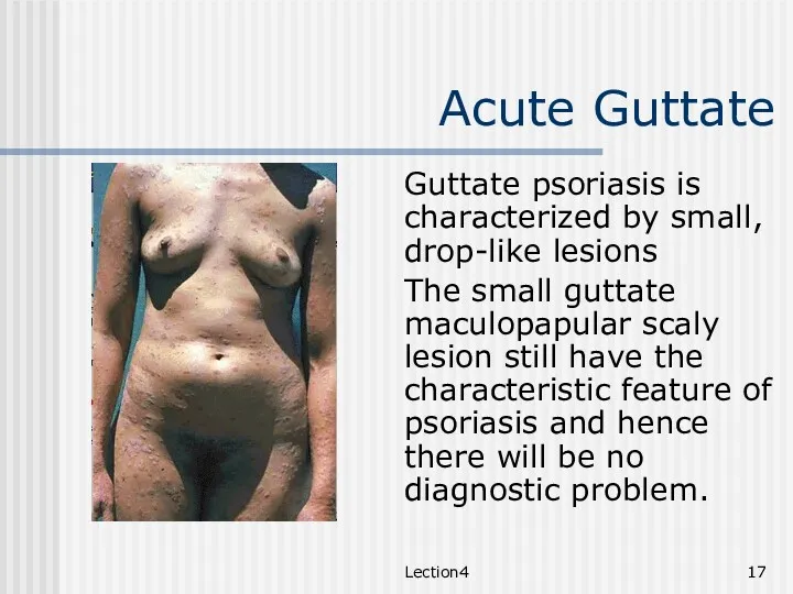 Lection4 Acute Guttate Guttate psoriasis is characterized by small, drop-like
