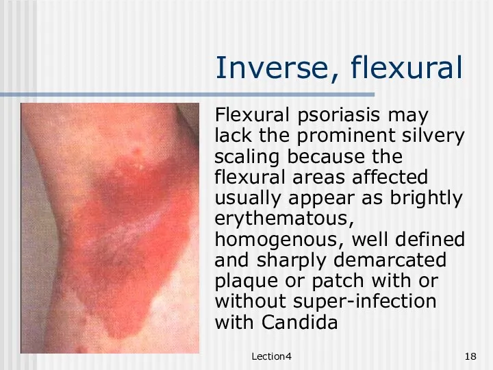 Lection4 Inverse, flexural Flexural psoriasis may lack the prominent silvery