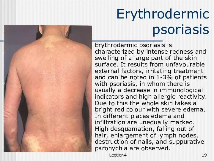 Lection4 Erythrodermic psoriasis Erythrodermic psoriasis is characterized by intense redness