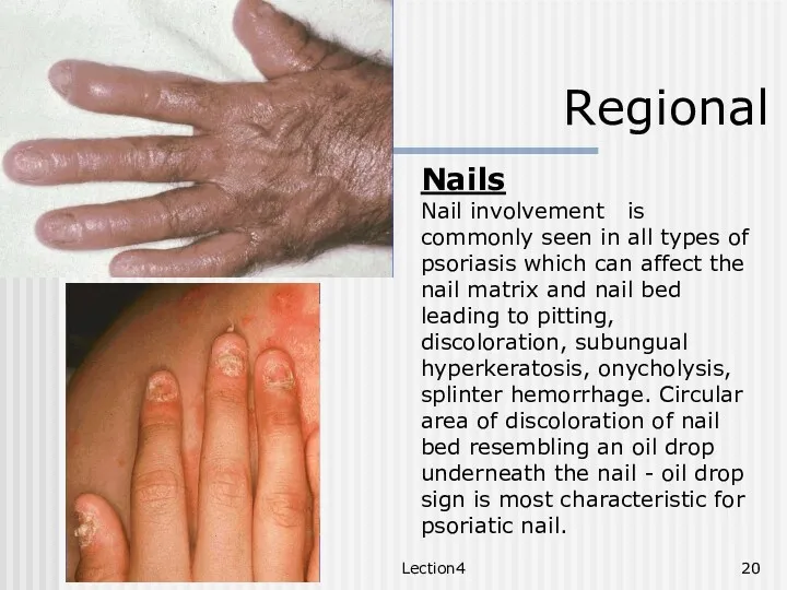 Lection4 Regional Nails Nail involvement is commonly seen in all