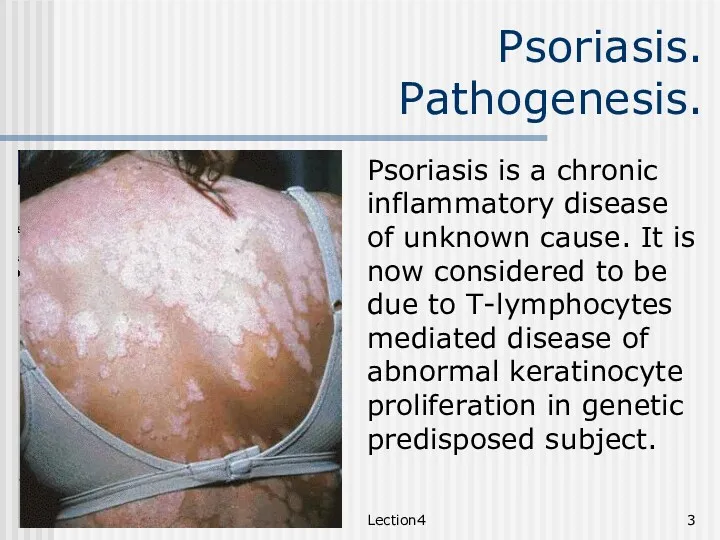 Lection4 Psoriasis. Pathogenesis. Psoriasis is a chronic inflammatory disease of