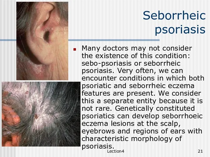 Lection4 Seborrheic psoriasis Many doctors may not consider the existence