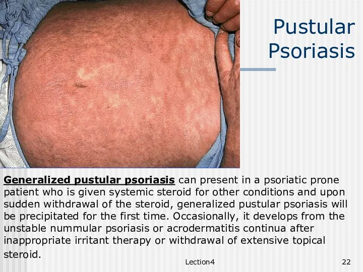 Lection4 Pustular Psoriasis Generalized pustular psoriasis can present in a