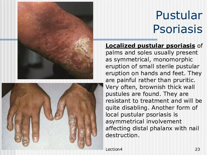 Lection4 Pustular Psoriasis Localized pustular psoriasis of palms and soles