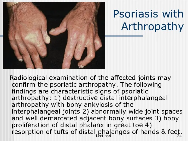 Lection4 Psoriasis with Arthropathy Radiological examination of the affected joints