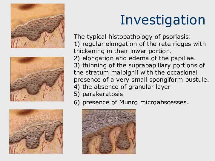 Investigation The typical histopathology of psoriasis: 1) regular elongation of