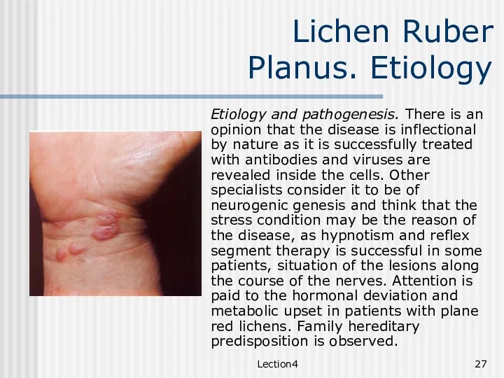Lection4 Lichen Ruber Planus. Etiology Etiology and pathogenesis. There is