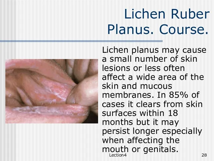 Lection4 Lichen Ruber Planus. Course. Lichen planus may cause a
