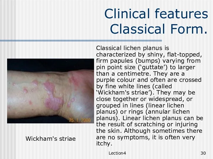 Lection4 Clinical features Classical Form. Classical lichen planus is characterized