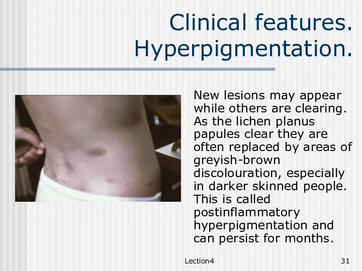 Lection4 Clinical features. Hyperpigmentation. New lesions may appear while others