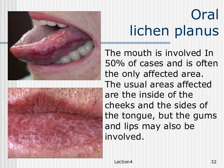 Lection4 Oral lichen planus The mouth is involved In 50%