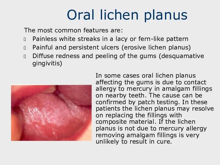 Oral lichen planus The most common features are: Painless white