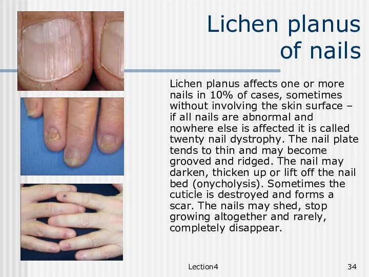 Lection4 Lichen planus of nails Lichen planus affects one or