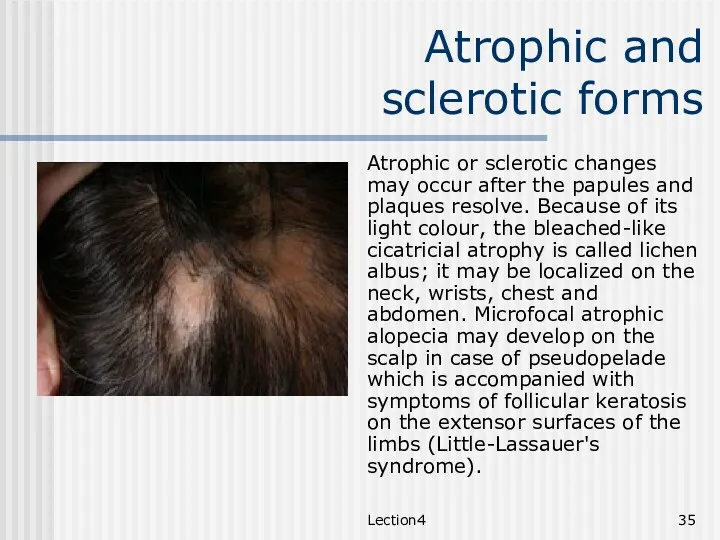 Lection4 Atrophic and sclerotic forms Atrophic or sclerotic changes may