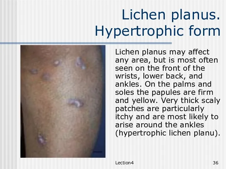 Lection4 Lichen planus. Hypertrophic form Lichen planus may affect any