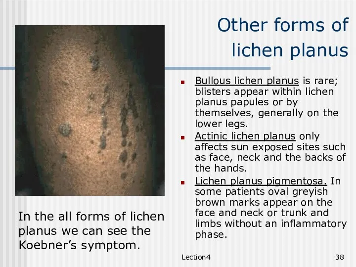 Lection4 Other forms of lichen planus Bullous lichen planus is