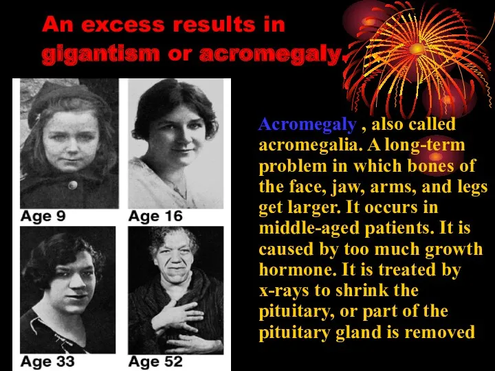 An excess results in gigantism or acromegaly. Acromegaly , also