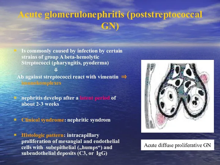 Acute glomerulonephritis (poststreptococcal GN) Is commonly caused by infection by