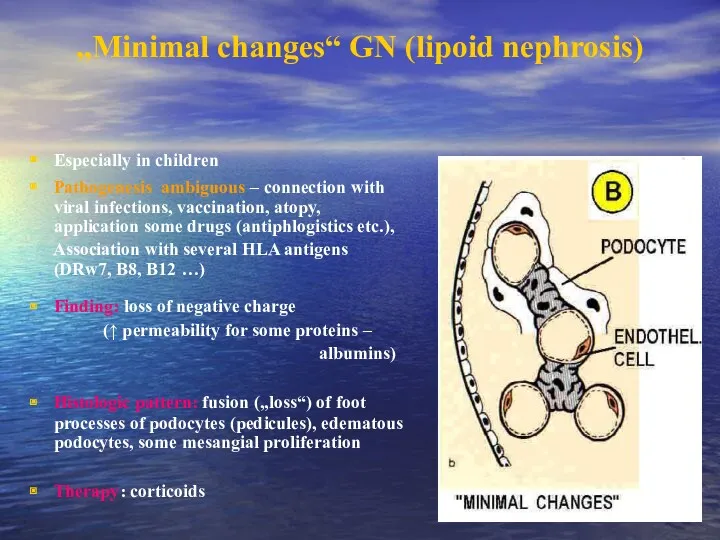 „Minimal changes“ GN (lipoid nephrosis) Especially in children Pathogenesis ambiguous