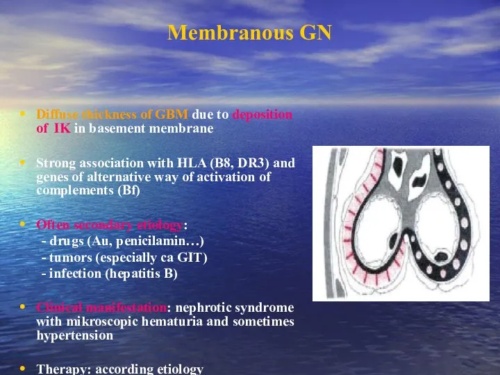 Membranous GN Diffuse thickness of GBM due to deposition of