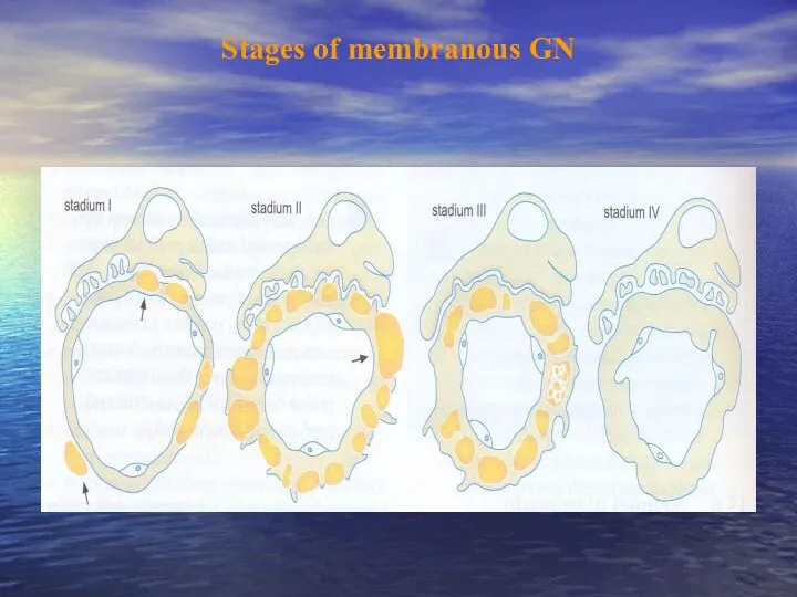 Stages of membranous GN