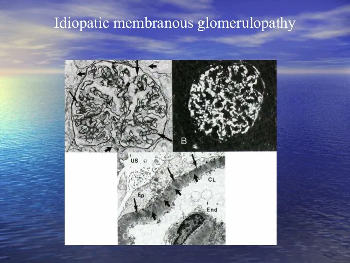 Idiopatic membranous glomerulopathy