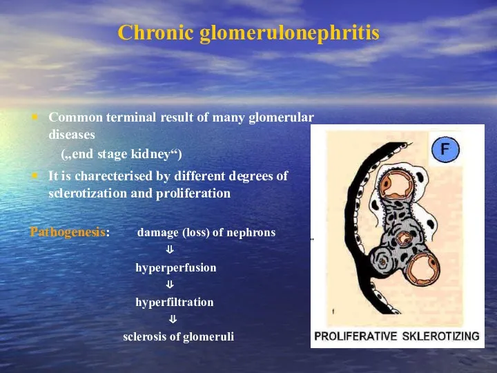Chronic glomerulonephritis Common terminal result of many glomerular diseases („end