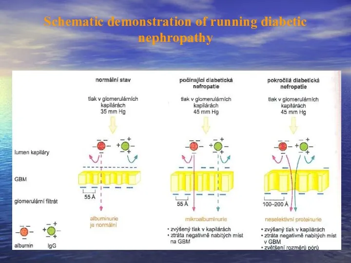 Schematic demonstration of running diabetic nephropathy