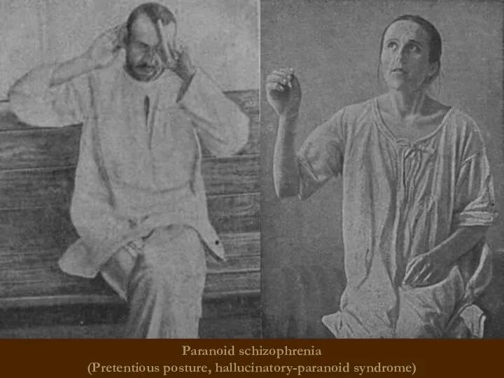 Paranoid schizophrenia (Pretentious posture, hallucinatory-paranoid syndrome)