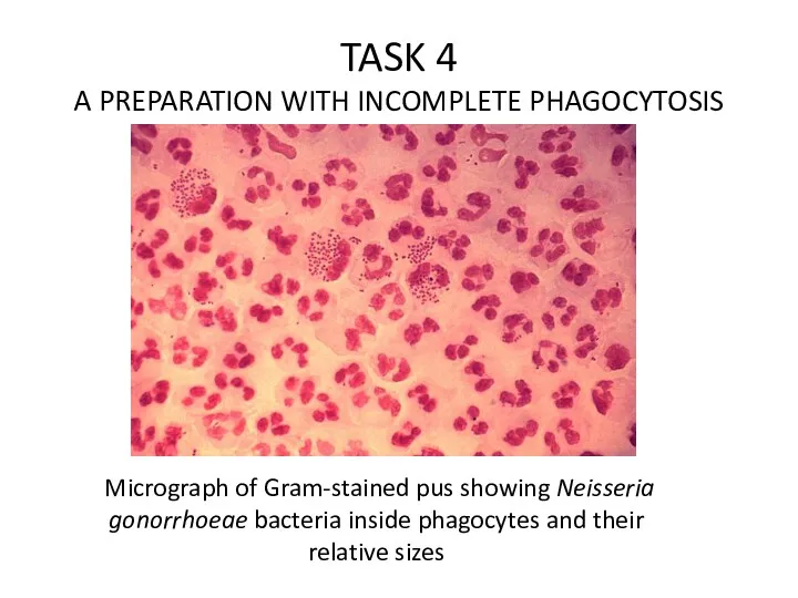 Micrograph of Gram-stained pus showing Neisseria gonorrhoeae bacteria inside phagocytes