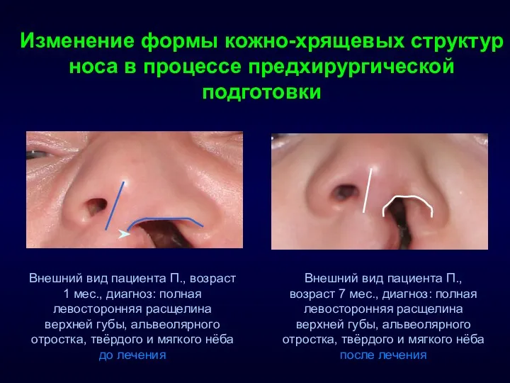 Изменение формы кожно-хрящевых структур носа в процессе предхирургической подготовки Внешний