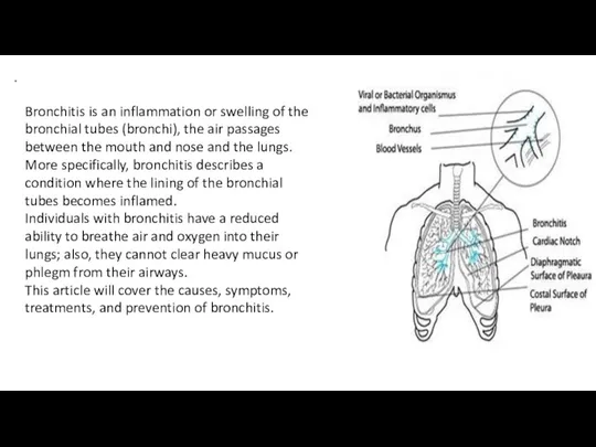 . Bronchitis is an inflammation or swelling of the bronchial