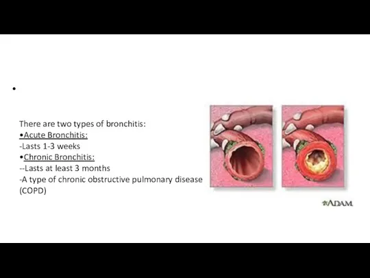 • There are two types of bronchitis: •Acute Bronchitis: -Lasts