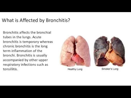 What is Affected by Bronchitis? Bronchitis affects the bronchial tubes