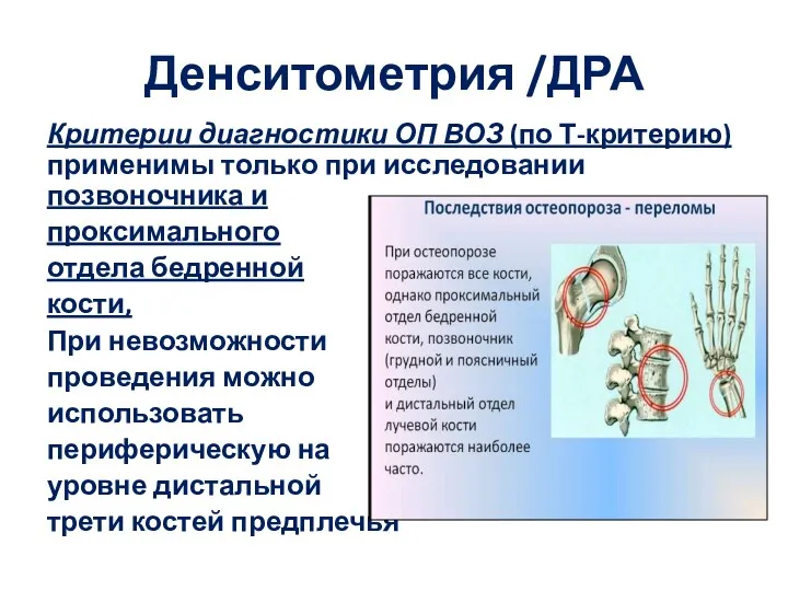 Денситометрия /ДРА Критерии диагностики ОП ВОЗ (по Т-критерию) применимы только