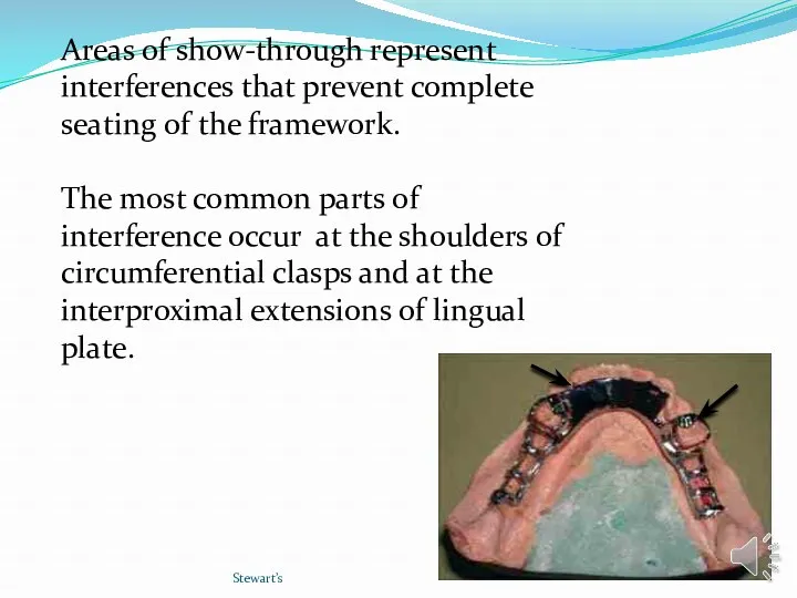 Stewart’s Areas of show-through represent interferences that prevent complete seating of the framework.