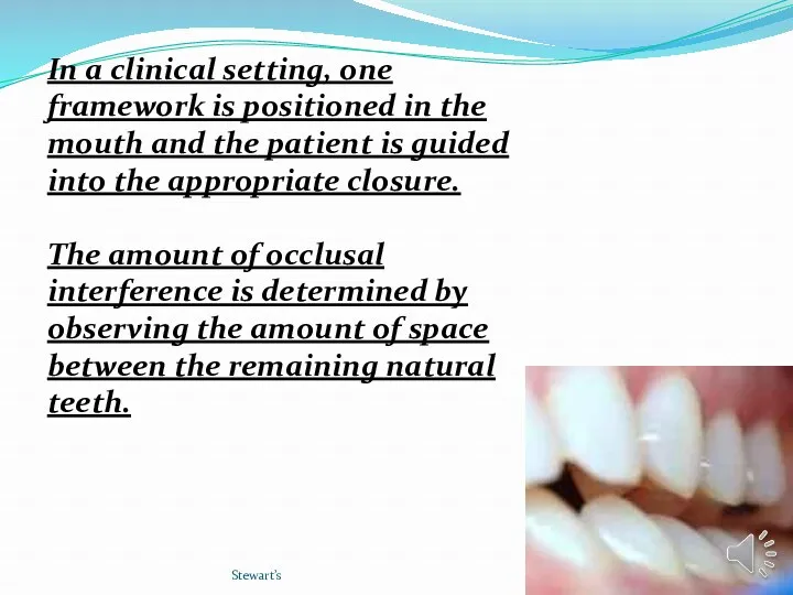 Stewart’s In a clinical setting, one framework is positioned in the mouth and