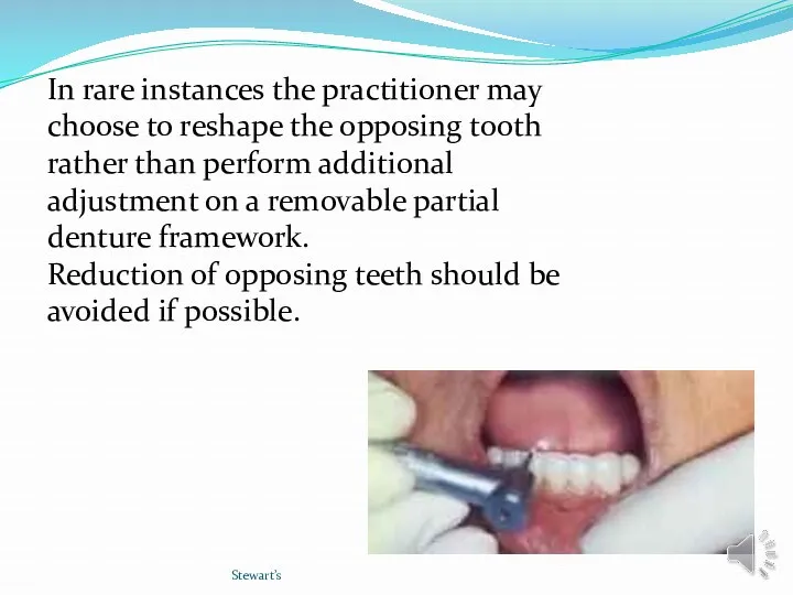 Stewart’s In rare instances the practitioner may choose to reshape the opposing tooth
