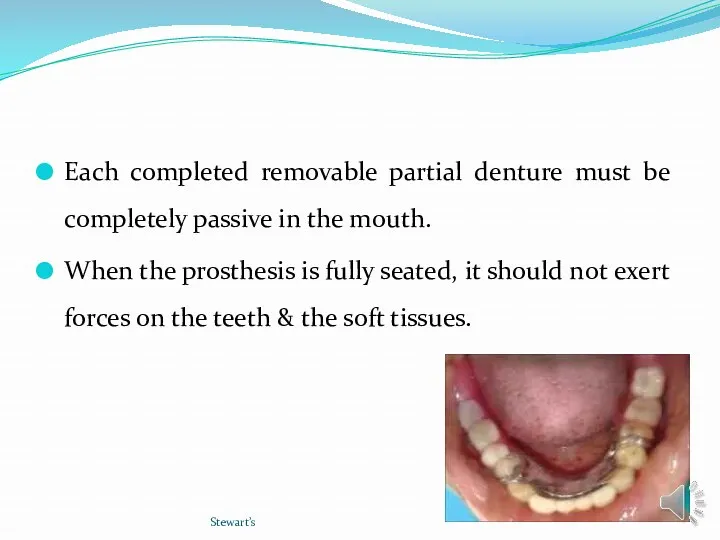 Each completed removable partial denture must be completely passive in the mouth. When