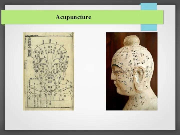 Acupuncture