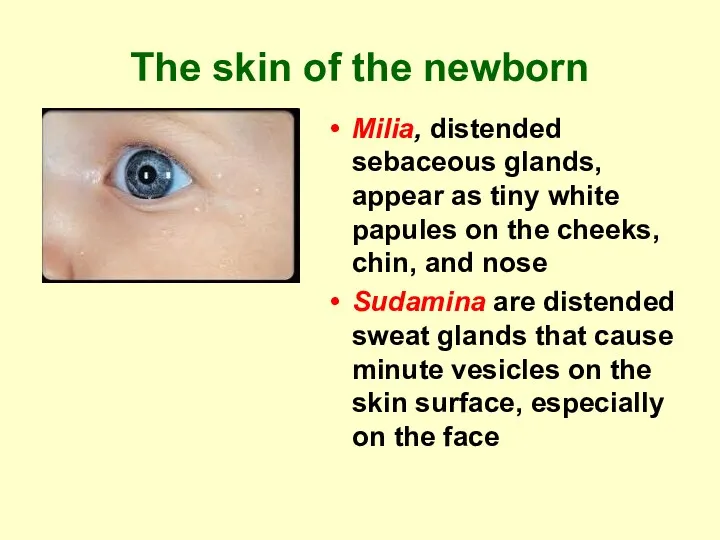 The skin of the newborn Milia, distended sebaceous glands, appear