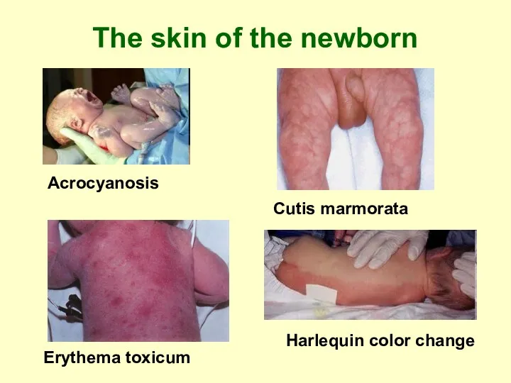 The skin of the newborn Acrocyanosis Cutis marmorata Erythema toxicum Harlequin color change