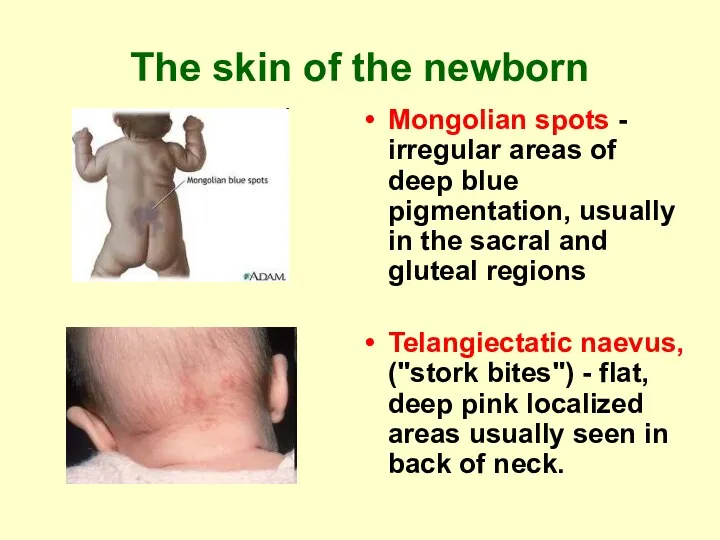 The skin of the newborn Mongolian spots - irregular areas