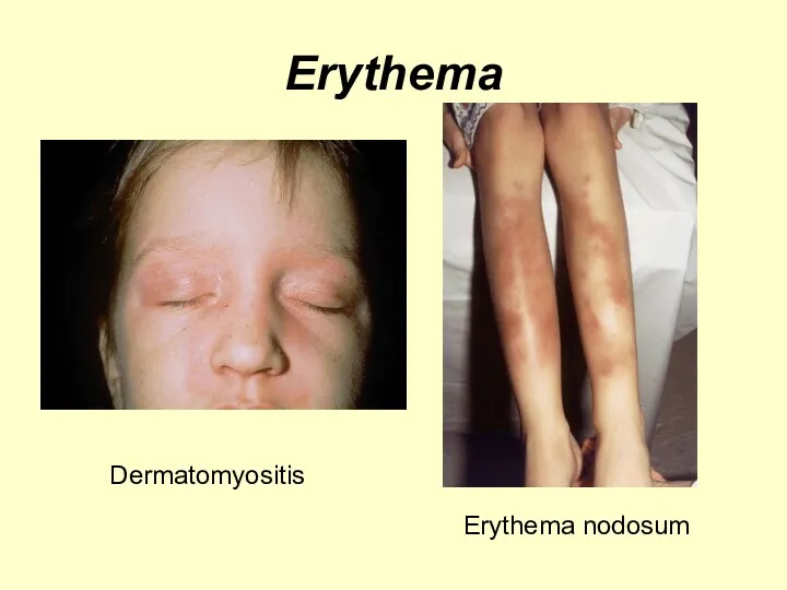 Erythema Dermatomyositis Erythema nodosum