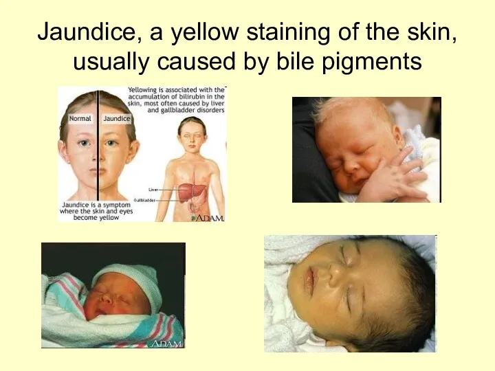 Jaundice, a yellow staining of the skin, usually caused by bile pigments