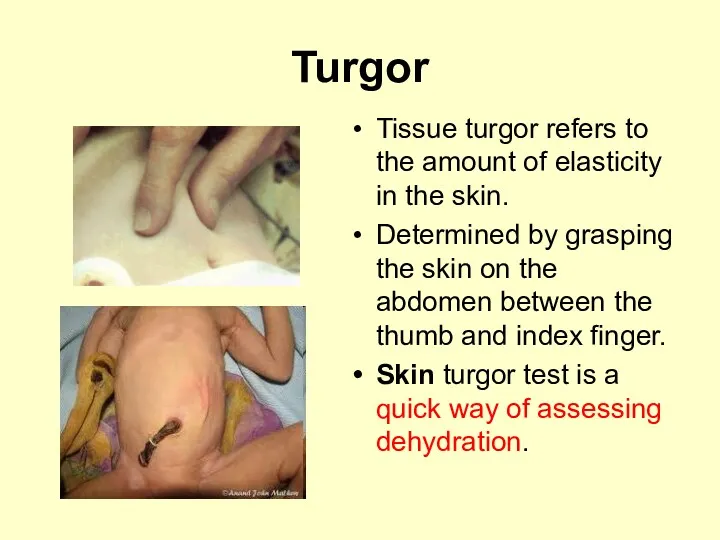 Turgor Tissue turgor refers to the amount of elasticity in